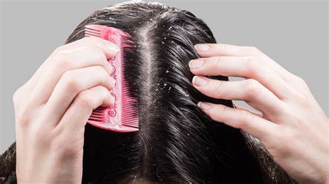 dandruff treatment