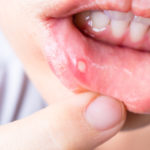 mouth-ulcer