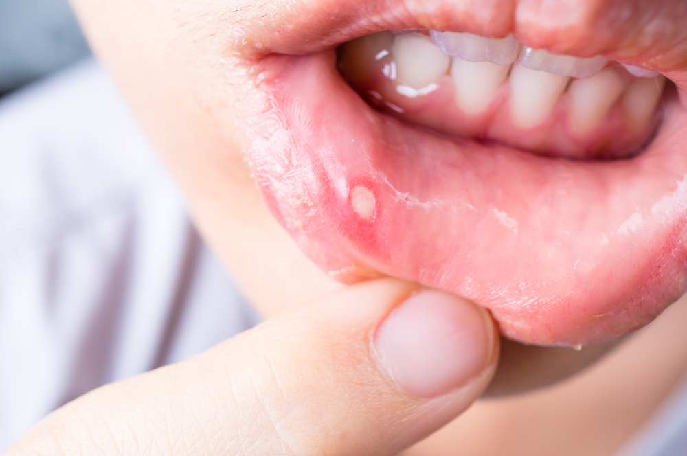 mouth-ulcer