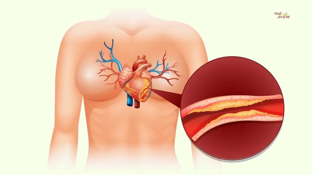 Does Diabetes Cause High Cholesterol