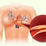 Does Diabetes Cause High Cholesterol